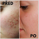 1+1 GRATIS: Gel premium STOP ACNE para pieles problemáticas y enrojecidas